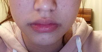 唇外翻图片,改善外观，重拾自信之美